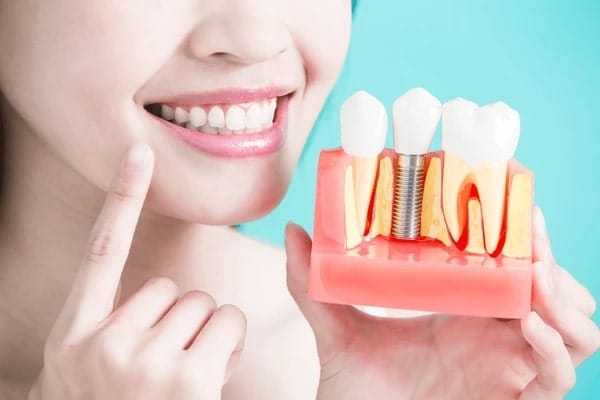 All-on-4 dental Implants
