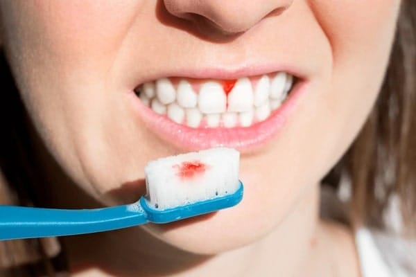 dental bleeding after extraction